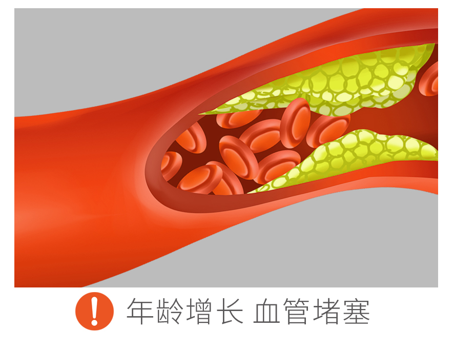 血管堵塞示意图